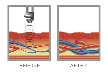 before and after gainswave therapy